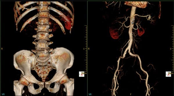 Scan by the NeuViz 16 Essence of a bone removal to view the nervous system