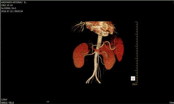 Scan by the NeuViz 16 Essence of the Renal system