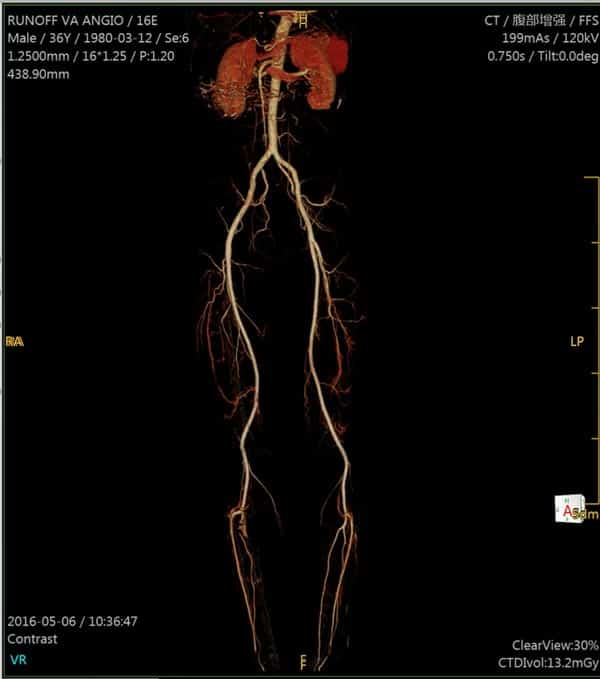 Scan by the NeuViz 16 Essence of renal system runoff