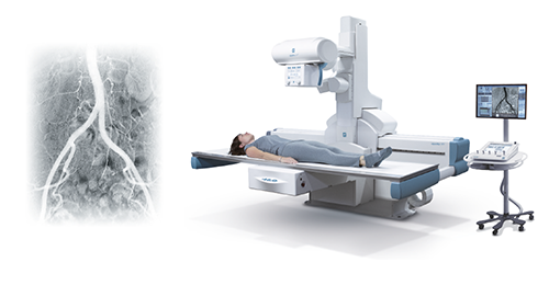 Left: angiogram of abdominal arteries; right: patient on a c‑arm fluoroscopy table in an interventional radiology suite with a monitoring screen.