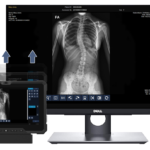 Medical imaging workstation showing a spine x‑ray on a dell monitor with mirrored images on handheld tablets for review and analysis.