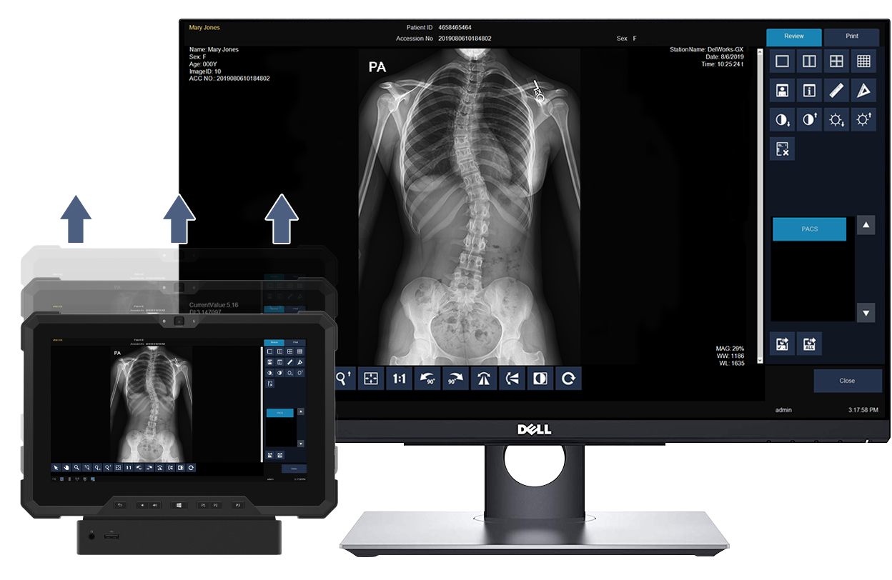 Medical imaging workstation showing a spine x‑ray on a dell monitor with mirrored images on handheld tablets for review and analysis.