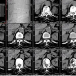 Medical imaging software showing a grid of axial cross-section slices of the neck/spine region, with a vertical toolbar on the right and multiple slice thumbnails in the grid.