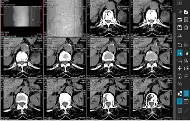 Medical imaging software showing a grid of axial cross-section slices of the neck/spine region, with a vertical toolbar on the right and multiple slice thumbnails in the grid.