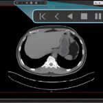 Axial ct scan of the upper abdomen showing the liver on the right, the spine in the center, and surrounding soft tissues. Curved artifact lines appear below the image.