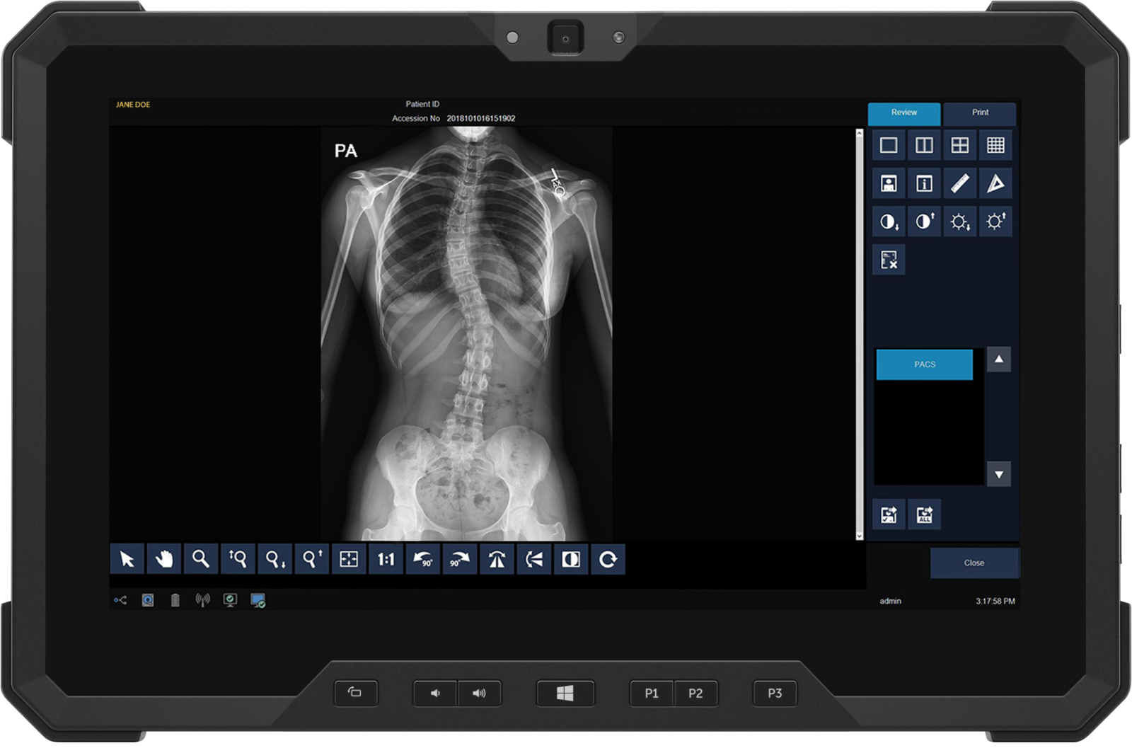 Medical monitor displaying a frontal chest x-ray (pa view) with ribs and spine visible, and a blue control panel on the right side of the screen.