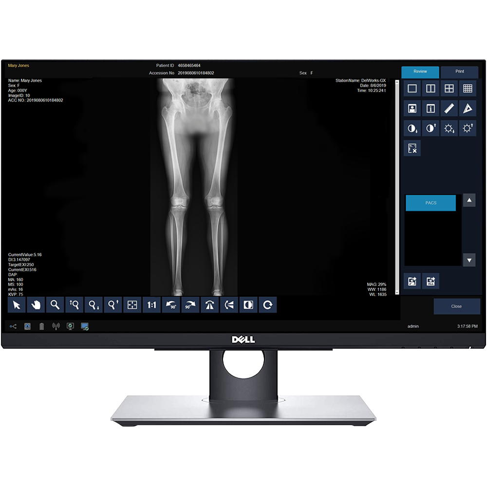 Medical image on a dell monitor showing a leg x-ray within imaging software; right-side tool panel and icons visible.