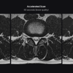 Triple panel axial brain mri comparison: conventional scan, accelerated scan, and accelerated scan with swiftmr