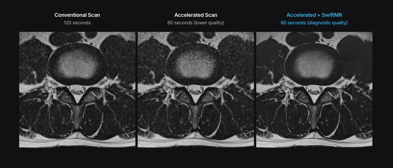Triple panel axial brain mri comparison: conventional scan, accelerated scan, and accelerated scan with swiftmr