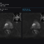 Side-by-side prostate mri comparison: left panel is conventional diffusion-weighted imaging (dwi), right panel swift dwi, both at 3t, with small adc inset in each panel.