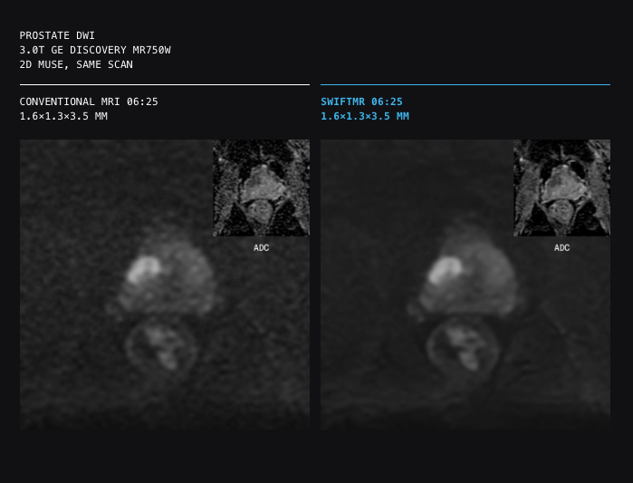 Side-by-side prostate mri comparison: left panel is conventional diffusion-weighted imaging (dwi), right panel swift dwi, both at 3t, with small adc inset in each panel.