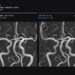 Side-by-side brain mr angiography images: left shows conventional 3d tof mra; right shows swiftmr mra, both illustrating cerebral arteries.