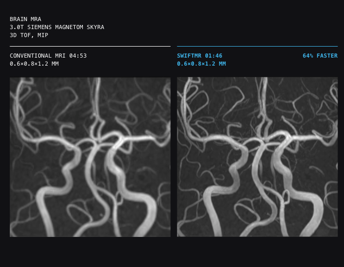 Side-by-side brain mr angiography images: left shows conventional 3d tof mra; right shows swiftmr mra, both illustrating cerebral arteries.