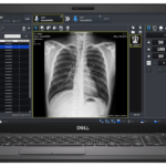 Dell laptop screen displaying a chest x-ray within medical imaging software interface on a radiology workstation