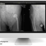 Computer monitor displaying two hip x-ray images, one with a left hip prosthesis, the other a different hip view, labeled as zero footprint viewer.