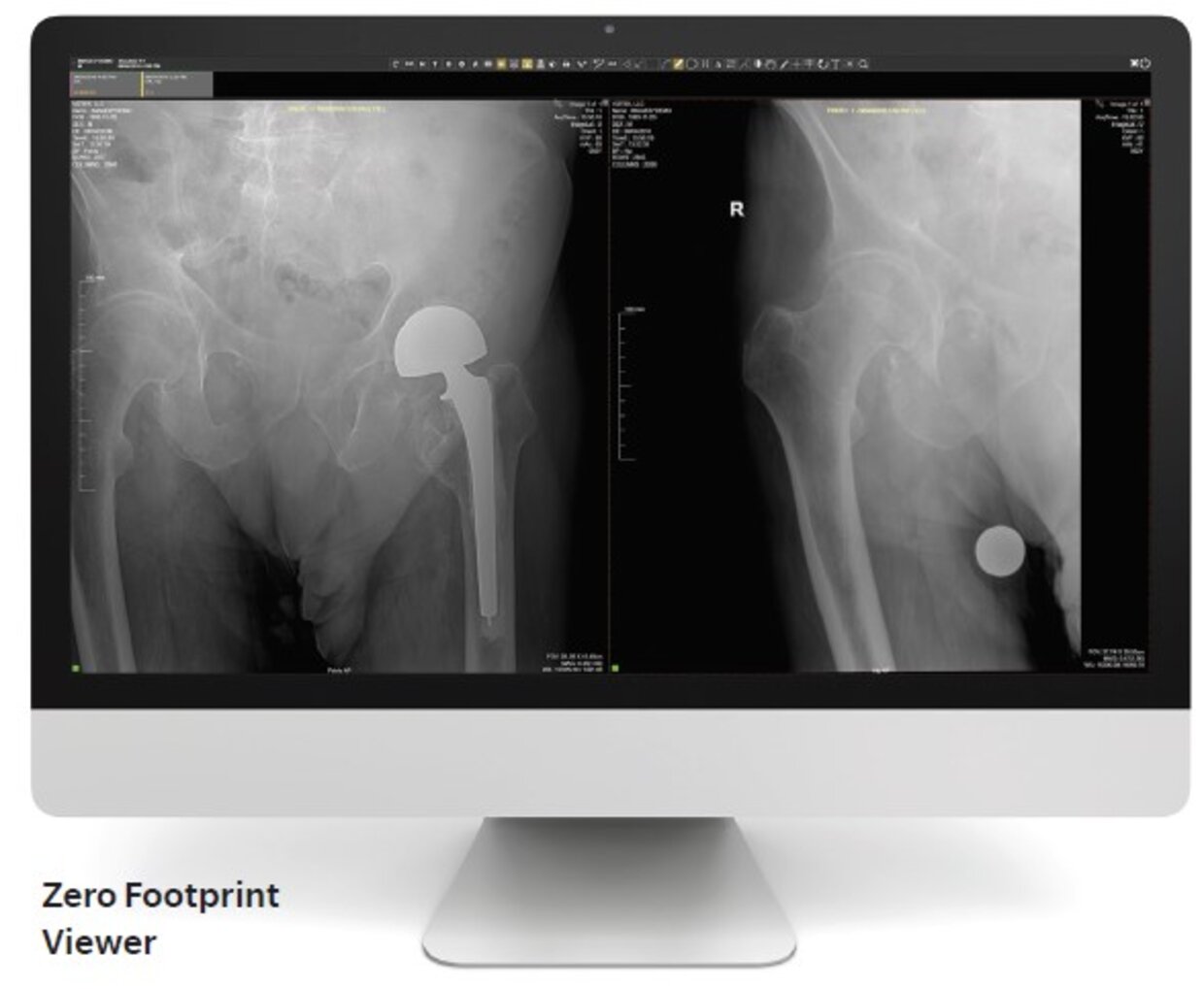 Computer monitor displaying two hip x-ray images, one with a left hip prosthesis, the other a different hip view, labeled as zero footprint viewer.